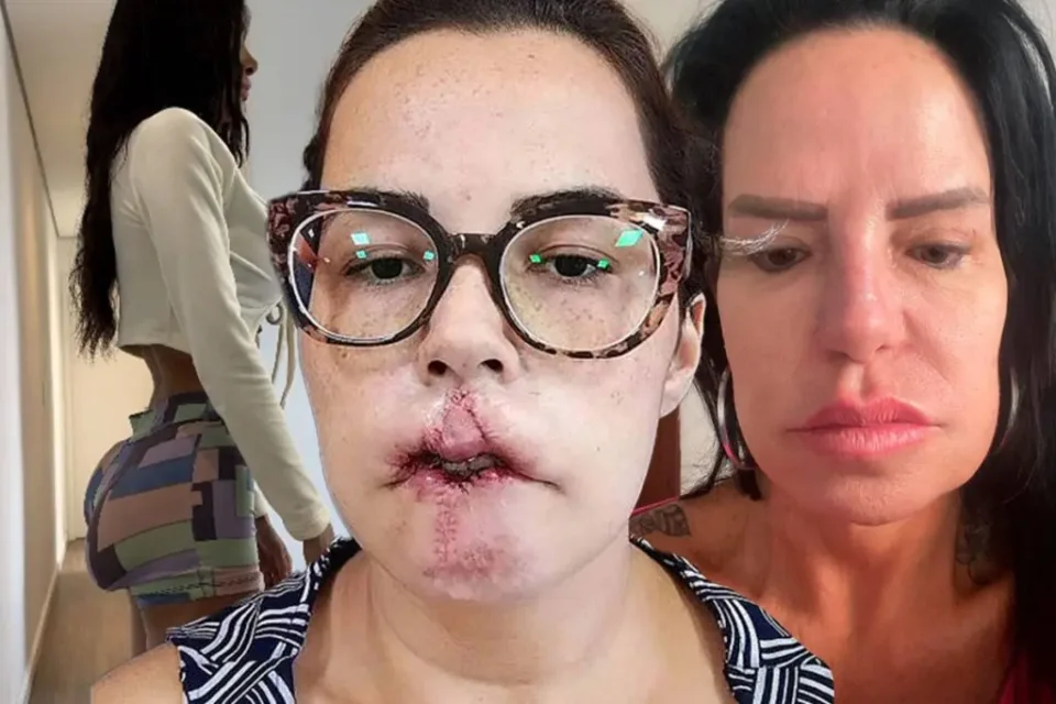 Dor e Arrependimento Após PMMA: Mulheres Compartilham Experiências